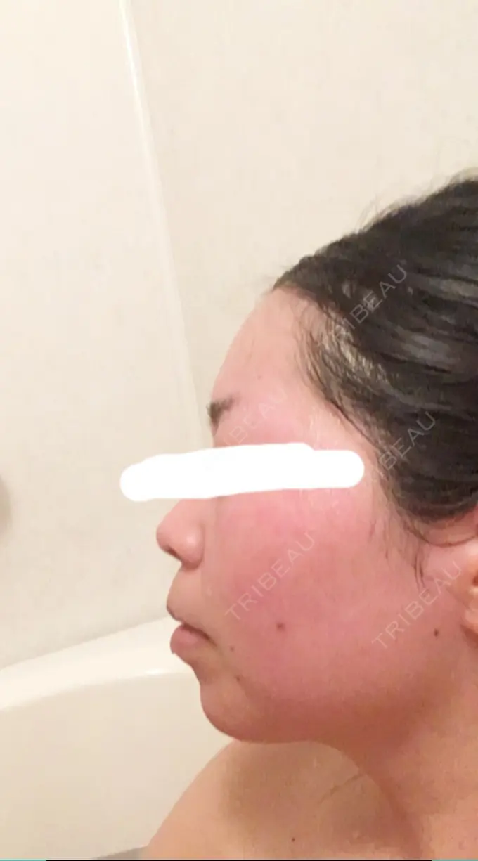 ボトックス（エラ・小顔） Wクリニック 心斎橋院 DAY 5 メイン用