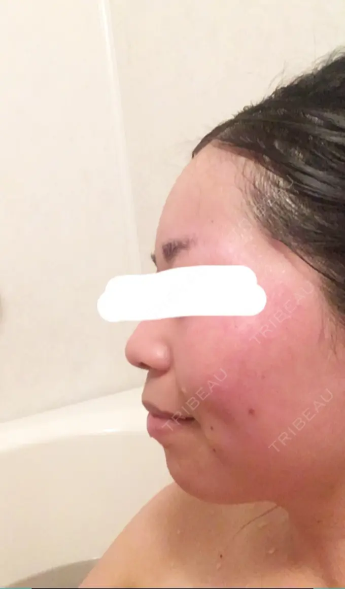 ボトックス（エラ・小顔） Wクリニック 心斎橋院 DAY 5 メイン用