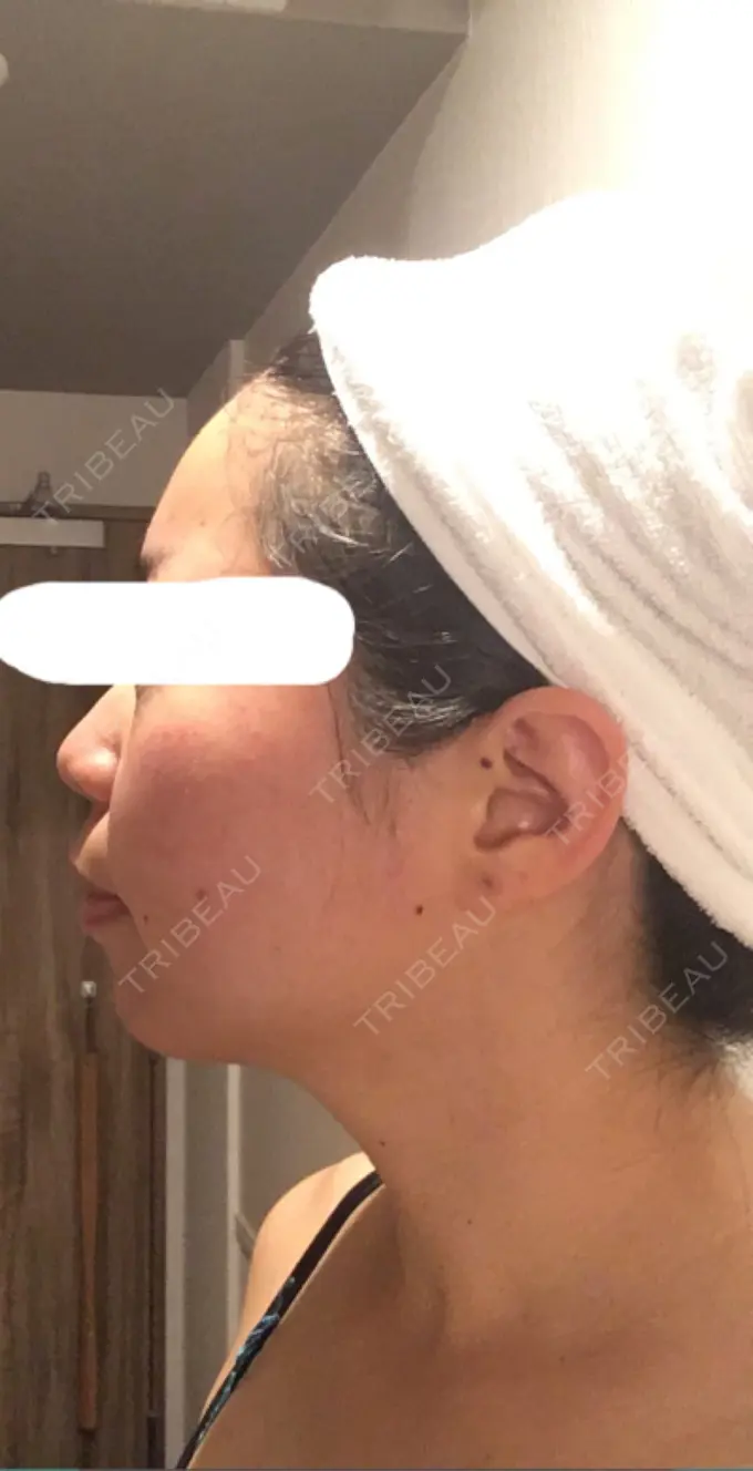 ボトックス（エラ・小顔） Wクリニック 心斎橋院 DAY 6 メイン用