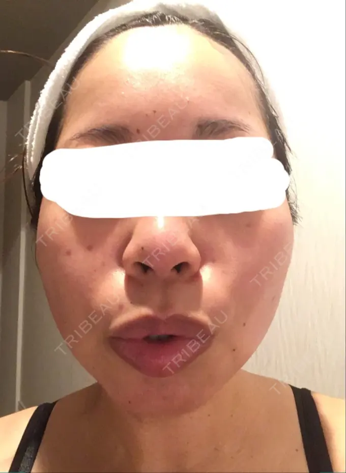 ボトックス（エラ・小顔） Wクリニック 心斎橋院 DAY 6 メイン用