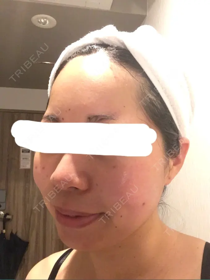 ボトックス（エラ・小顔） Wクリニック 心斎橋院 DAY 6 メイン用