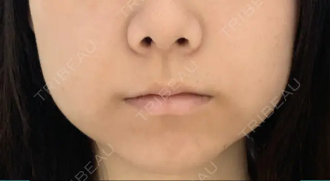 ボトックス（エラ・小顔） / 脂肪溶解注射（顔） ビクアスクリニック DAY 6 メイン用