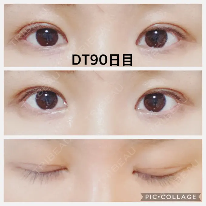 二重切開 水の森美容クリニック 名古屋院 AFTER メイン用