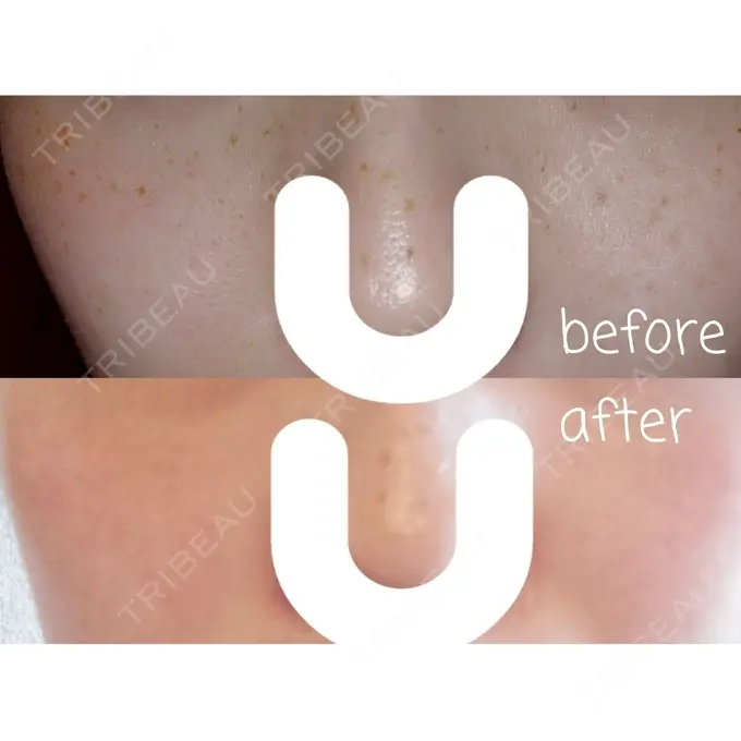 美肌レーザー / シミ取りレーザー / ルビーレーザー 銀座お肌の診療所 DAY 15 メイン用