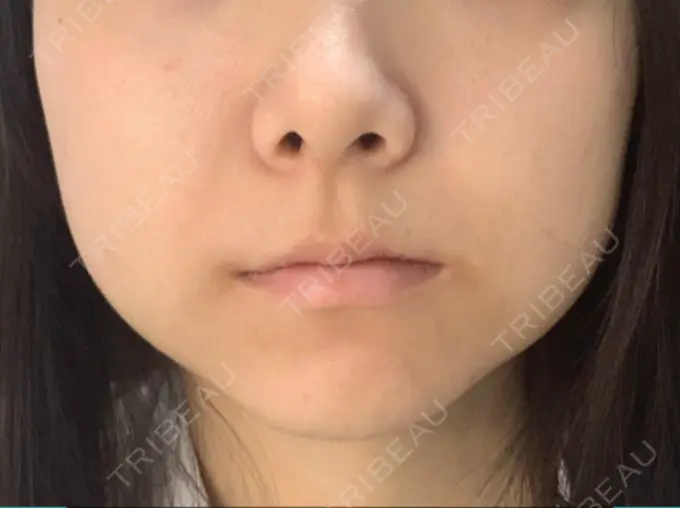 ボトックス（エラ・小顔） / 脂肪溶解注射（顔） ビクアスクリニック DAY 7 メイン用