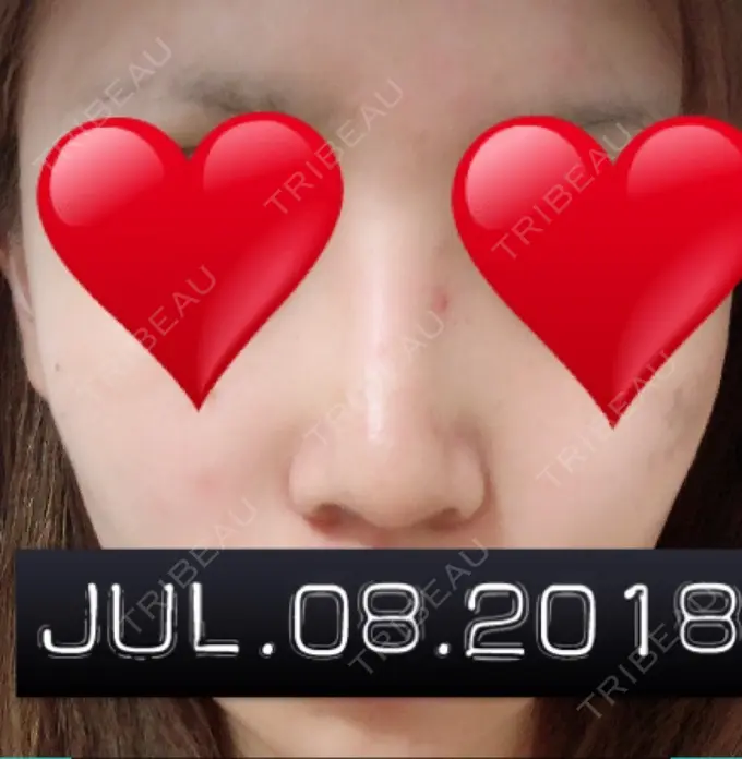 隆鼻術 / 鼻中隔延長（切開） / 軟骨移植 ジュエリー美容外科 DAY 31 メイン用