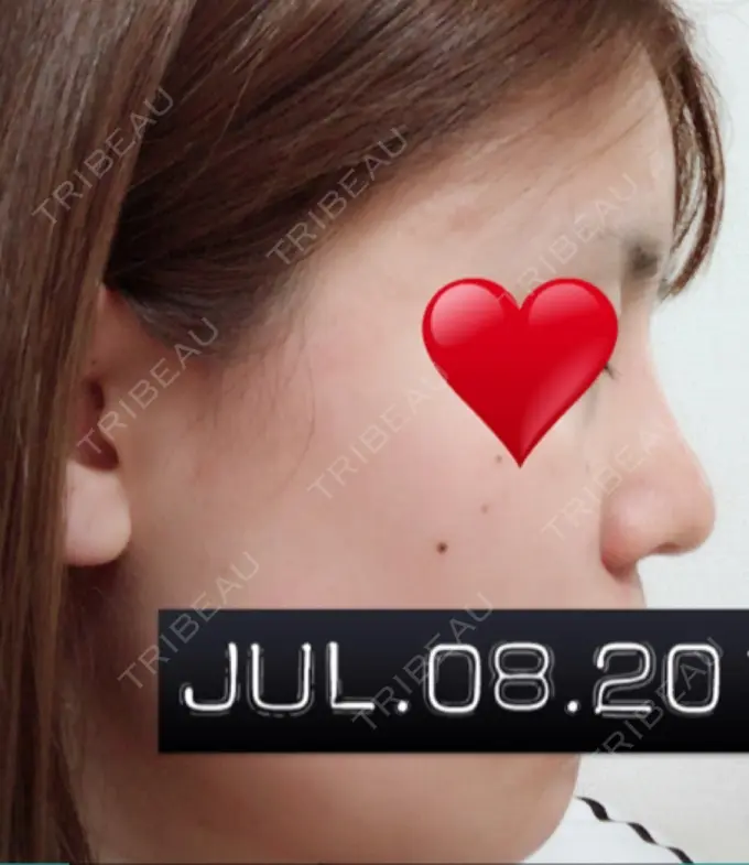 隆鼻術 / 鼻中隔延長（切開） / 軟骨移植 ジュエリー美容外科 DAY 31 メイン用