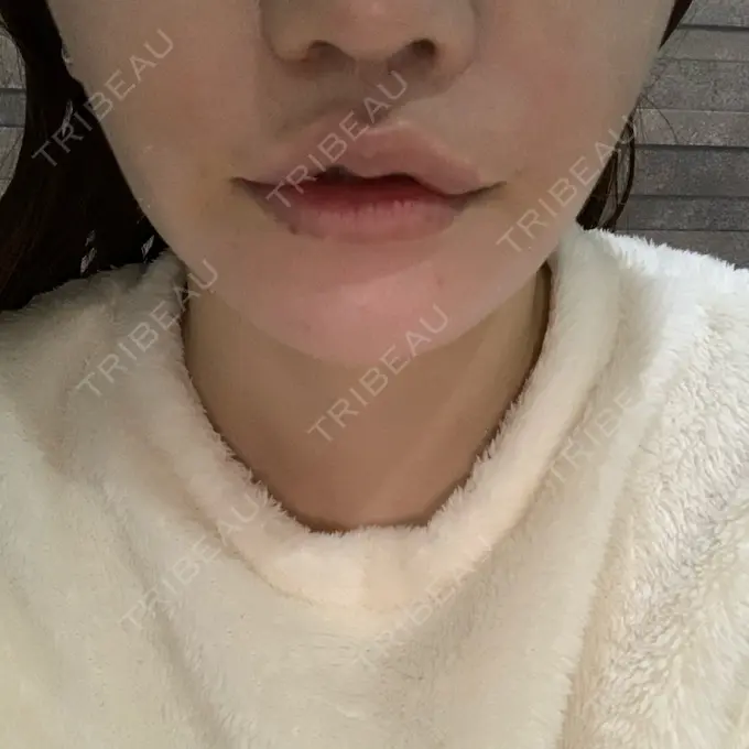 口角挙上 現代美学整形外科 AFTER メイン用