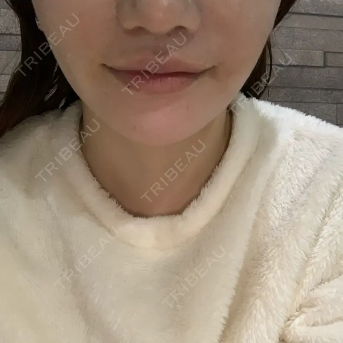 口角挙上 現代美学整形外科 DAY 82 メイン用