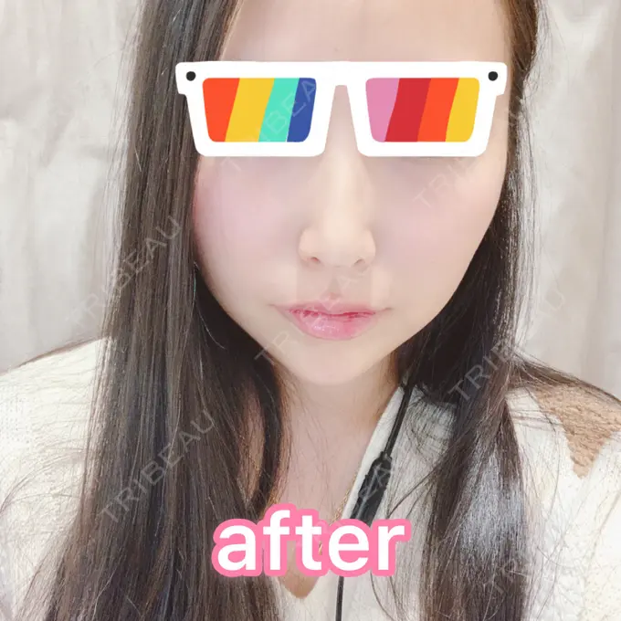 ヒアルロン酸注入（鼻） / ヒアルロン酸注入（あご） / ヒアルロン酸注入（唇） BIANCA銀座 DAY 0 メイン用