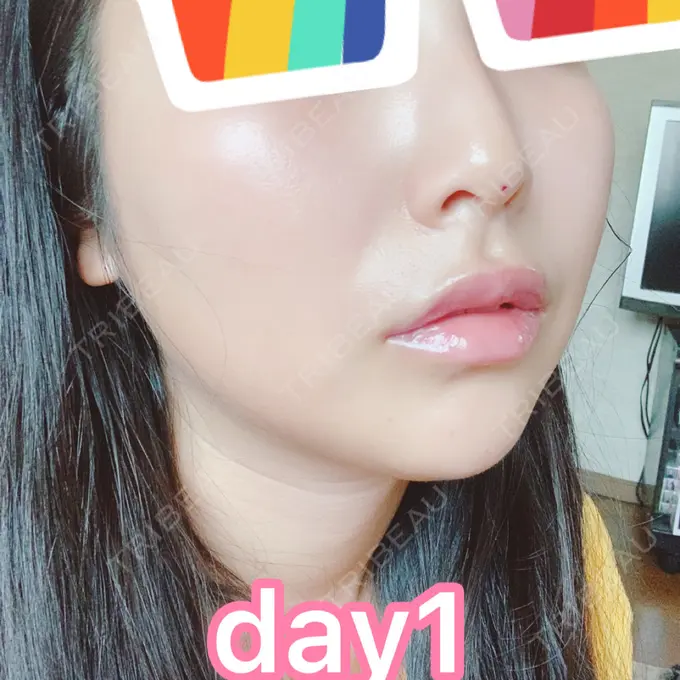 ヒアルロン酸注入（鼻） / ヒアルロン酸注入（あご） / ヒアルロン酸注入（唇） BIANCA銀座 DAY 1 メイン用