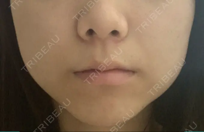 ボトックス（エラ・小顔） / 脂肪溶解注射（顔） ビクアスクリニック DAY 9 メイン用