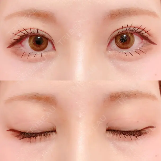 二重切開 / 上まぶたの脂肪取り / その他（目元） 銀座高須クリニック DAY 126 メイン用