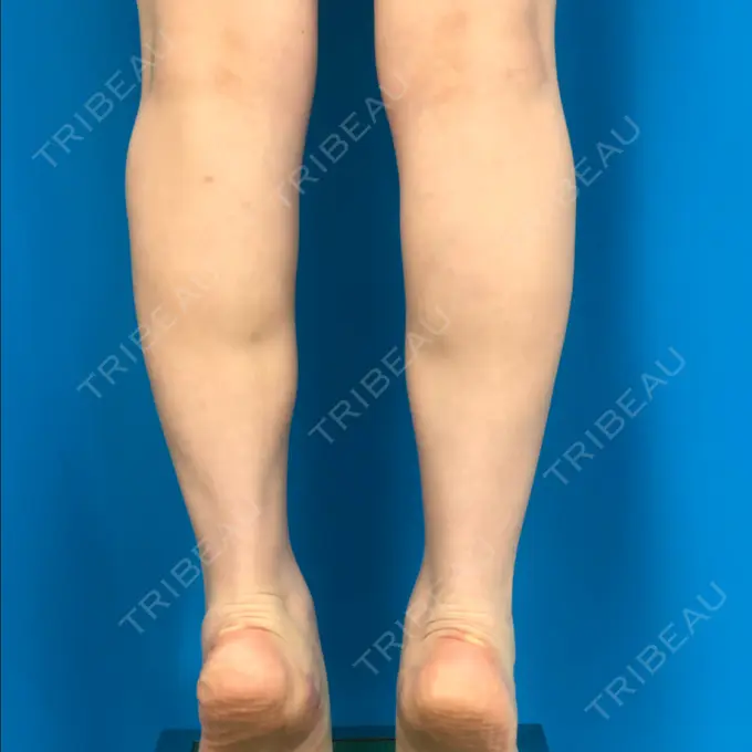 ボトックス（ふくらはぎ） ガーデンクリニック 名古屋院 AFTER メイン用