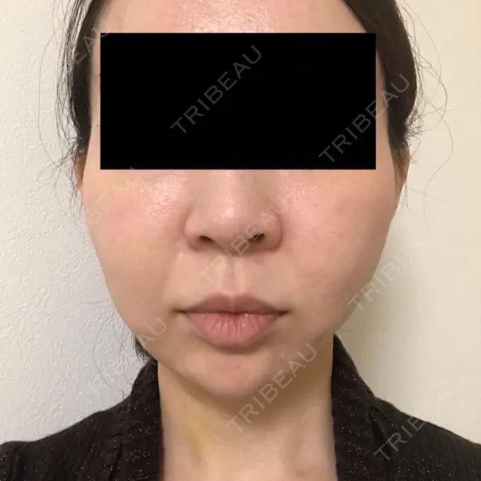 脂肪吸引（顔） GRACIA clinic 【グラシアクリニック】 DAY 10 メイン用