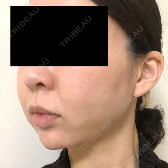 脂肪吸引（顔） GRACIA clinic 【グラシアクリニック】 DAY 10 メイン用