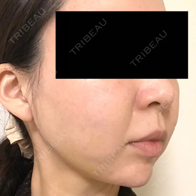 脂肪吸引（顔） GRACIA clinic 【グラシアクリニック】 DAY 10 メイン用