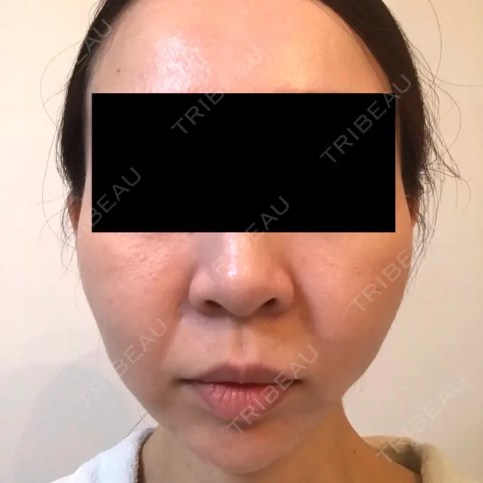 脂肪吸引（顔） GRACIA clinic 【グラシアクリニック】 DAY 14 メイン用