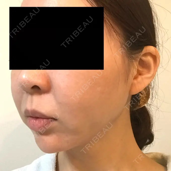 脂肪吸引（顔） GRACIA clinic 【グラシアクリニック】 DAY 14 メイン用