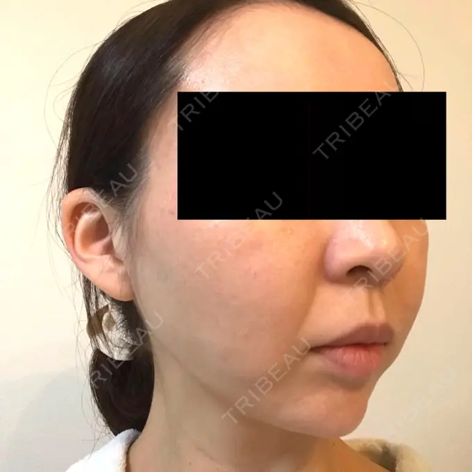 脂肪吸引（顔） GRACIA clinic 【グラシアクリニック】 DAY 14 メイン用