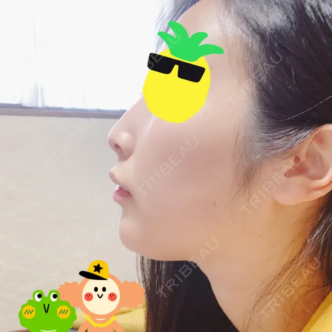 ヒアルロン酸注入（鼻） / ヒアルロン酸注入（あご） / ヒアルロン酸注入（唇） BIANCA銀座 AFTER メイン用