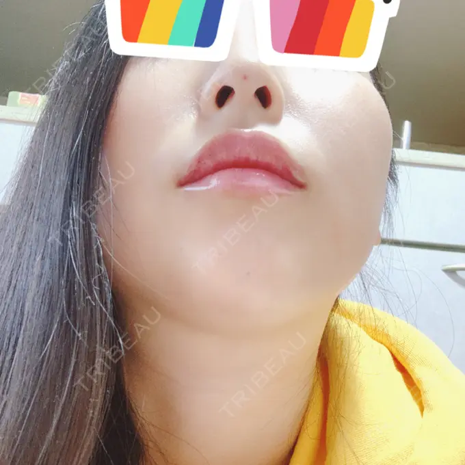 ヒアルロン酸注入（鼻） / ヒアルロン酸注入（あご） / ヒアルロン酸注入（唇） BIANCA銀座 DAY 2 メイン用