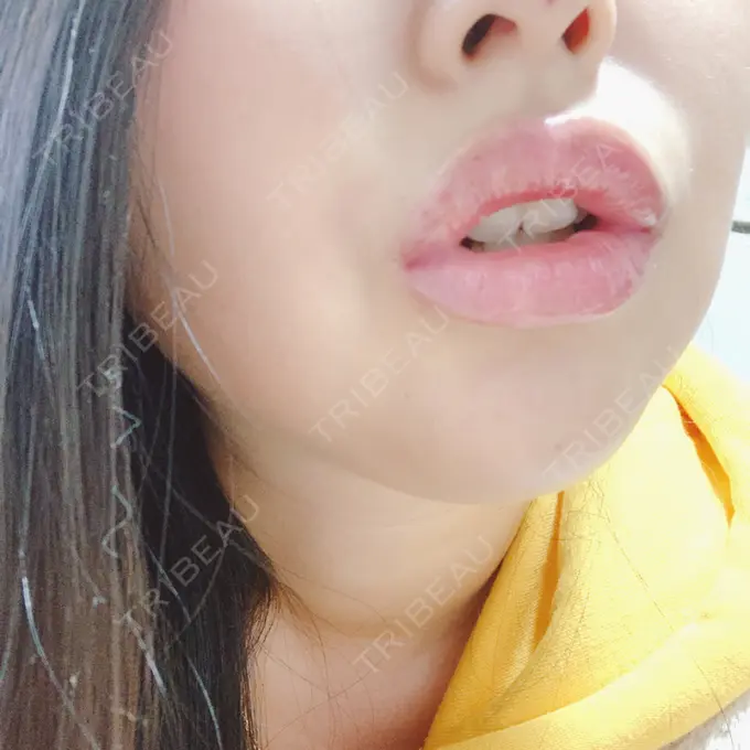 ヒアルロン酸注入（鼻） / ヒアルロン酸注入（あご） / ヒアルロン酸注入（唇） BIANCA銀座 DAY 2 メイン用