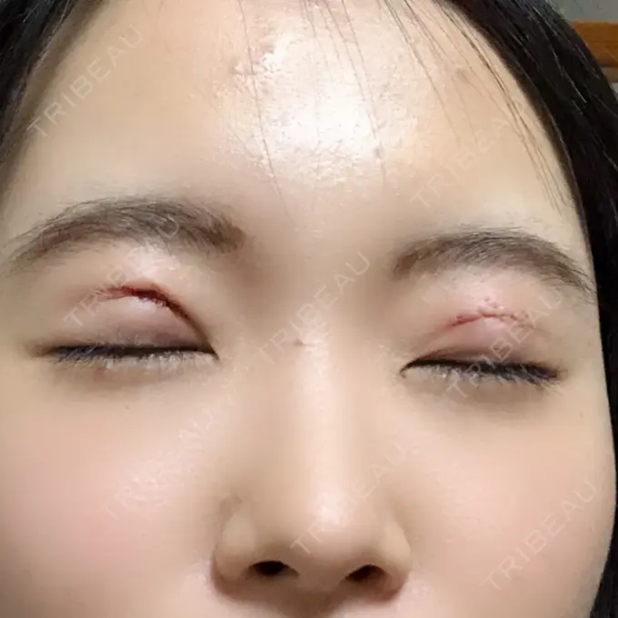 二重切開 ジョウクリニック 高知院 DAY 0 メイン用