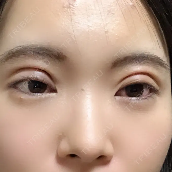 二重切開 ジョウクリニック 高知院 DAY 0 メイン用