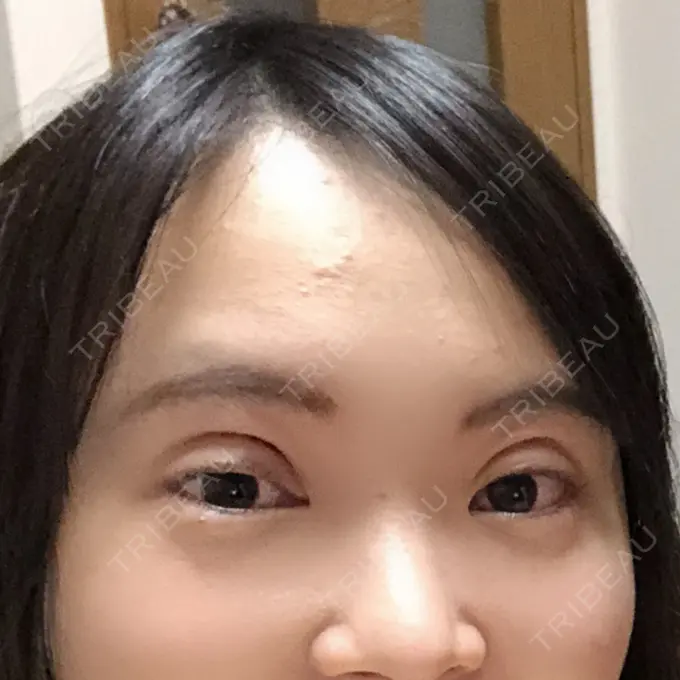 二重切開 ジョウクリニック 高知院 DAY 0 メイン用