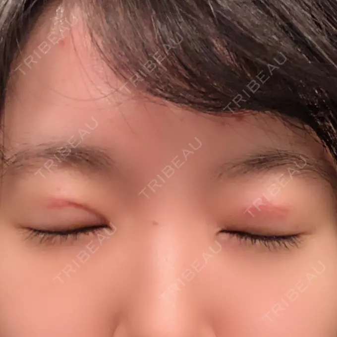 二重切開 ジョウクリニック 高知院 DAY 7 メイン用