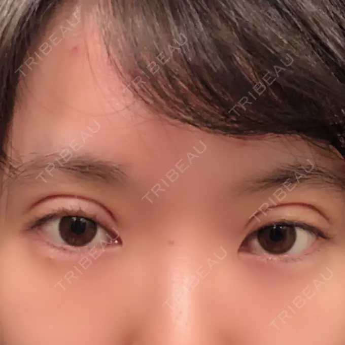 二重切開 ジョウクリニック 高知院 DAY 7 メイン用