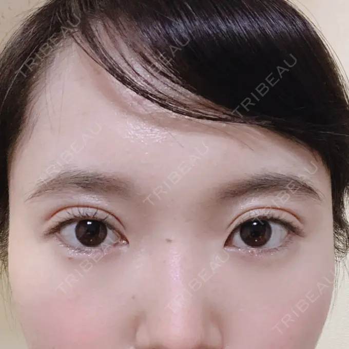 二重切開 ジョウクリニック 高知院 DAY 27 メイン用