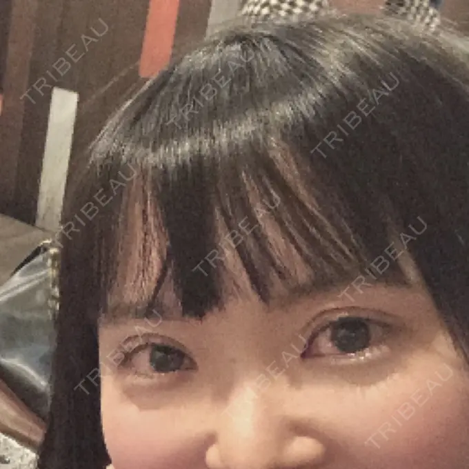 二重切開 ジョウクリニック 高知院 AFTER メイン用