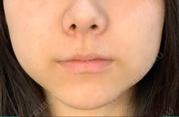 ボトックス（エラ・小顔） / 脂肪溶解注射（顔） ビクアスクリニック DAY 10 メイン用