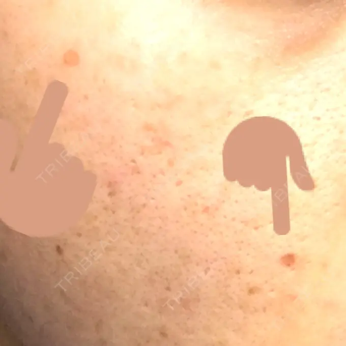 ほくろ・いぼ切除（肌） 金沢中央クリニック DAY 20 メイン用