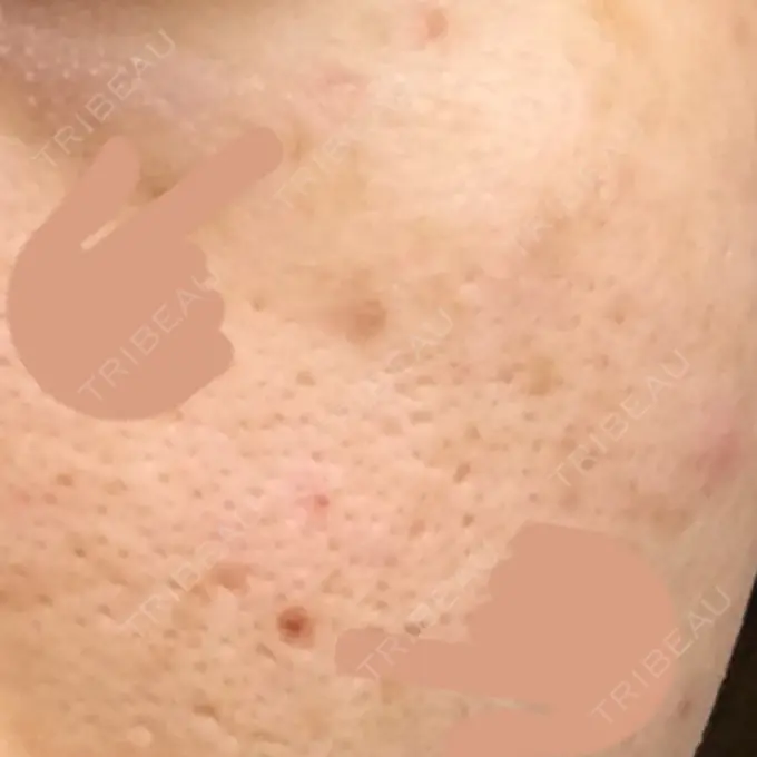 ほくろ・いぼ切除（肌） 金沢中央クリニック DAY 20 メイン用