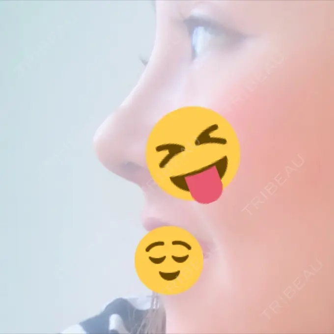 隆鼻術 / 鼻尖形成（切開） / 鼻中隔延長（切開） / 眉間プロテーゼ FROM B整形外科 (旧バウム整形外科) DAY 15 メイン用