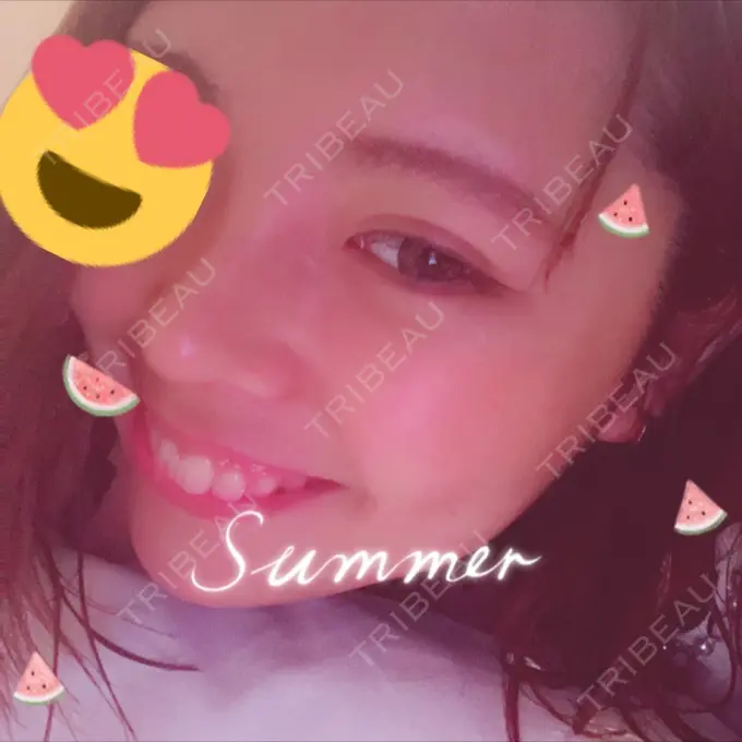 隆鼻術 / 鼻尖形成（切開） / 鼻中隔延長（切開） / 眉間プロテーゼ FROM B整形外科 (旧バウム整形外科) DAY 15 メイン用