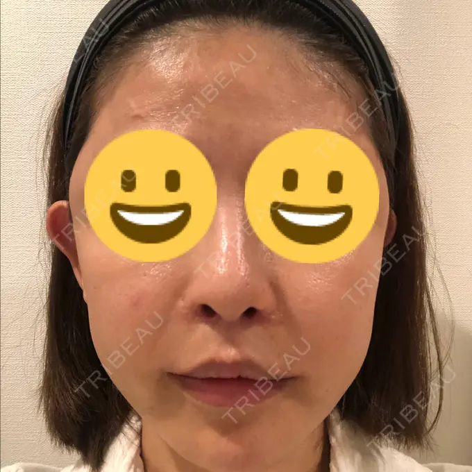 人中短縮 / 口角挙上 清潭女神美容外科 AFTER メイン用