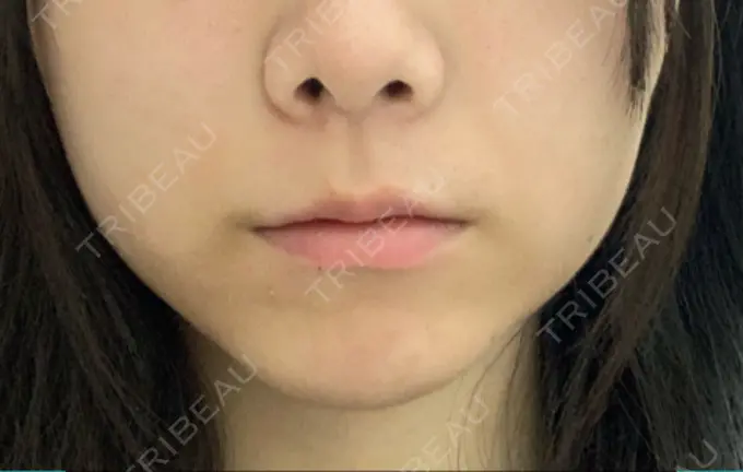 ボトックス（エラ・小顔） / 脂肪溶解注射（顔） ビクアスクリニック DAY 11 メイン用