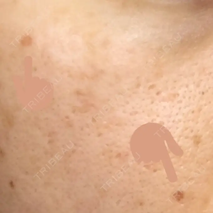 ほくろ・いぼ切除（肌） 金沢中央クリニック DAY 21 メイン用