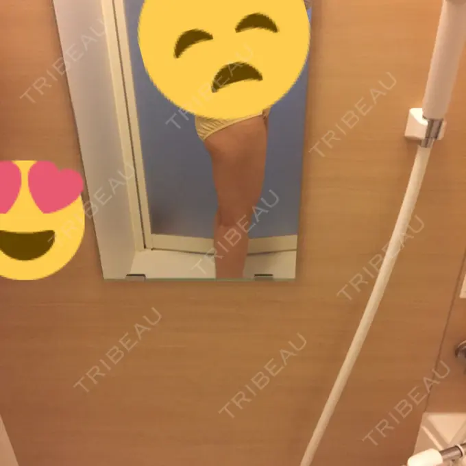 脂肪吸引（脚） / 脂肪吸引（お尻） ヨンセスリムライン DAY 46 メイン用