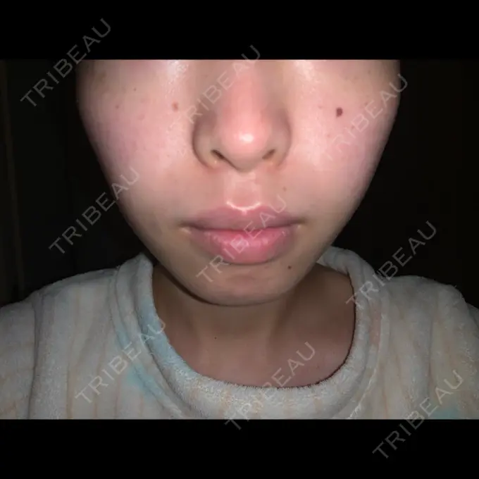 シミ取りレーザー / フォトRF 木本整形外科クリニック アンチエイジング美容外来センター DAY 9 メイン用