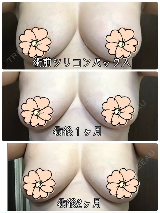 豊胸（脂肪注入） / 胸修正 / 脂肪注入（額） THE CLINIC（ザ・クリニック） 大阪院 DAY 58 メイン用