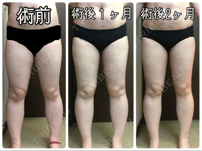 豊胸（脂肪注入） / 胸修正 / 脂肪注入（額） THE CLINIC（ザ・クリニック） 大阪院 DAY 58 メイン用