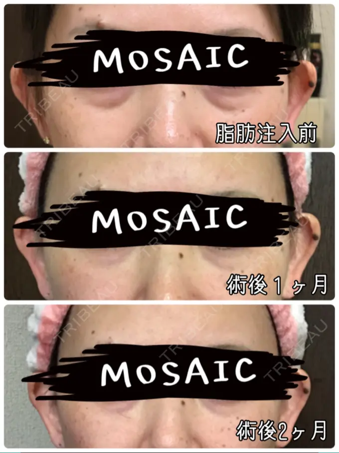 豊胸（脂肪注入） / 胸修正 / 脂肪注入（額） THE CLINIC（ザ・クリニック） 大阪院 DAY 58 メイン用