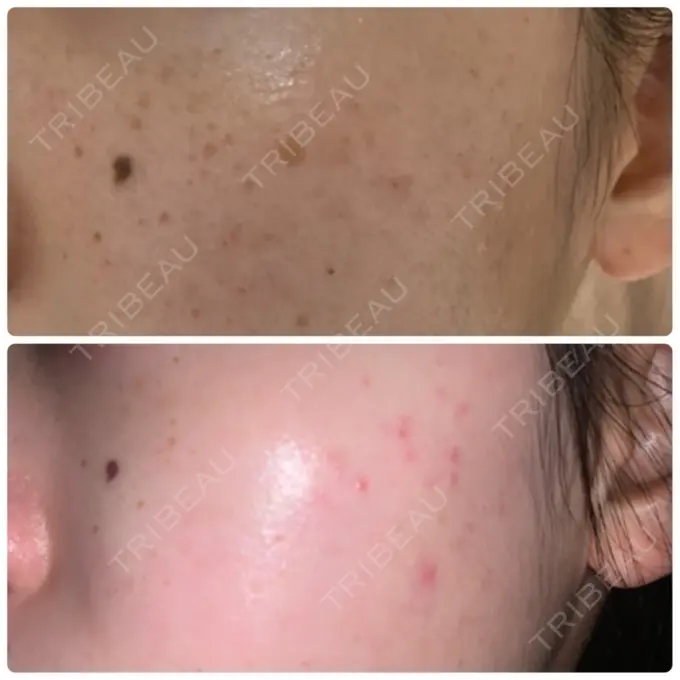 シミ取りレーザー / フォトRF 木本整形外科クリニック アンチエイジング美容外来センター DAY 10 メイン用