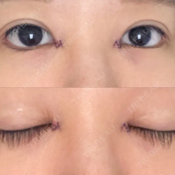蒙古ひだ形成 / 目元修正 銀座高須クリニック DAY 2 メイン用