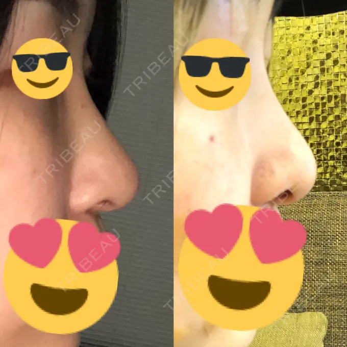 隆鼻術 / 軟骨移植 / 骨切幅寄せ / 鼻尖縮小 / その他（鼻） 韓国BBクリニック（旧 シンミアン形成外科） DAY 88 メイン用